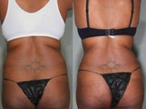 Vaser LipoSuction 31 Year Old female Treated For Unwanted Fat