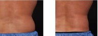 CoolSculpting for Fat Reduction in the Love Handles