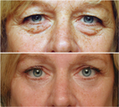 Laser resurfacing, Blepharoplasty