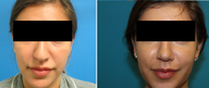 Rhinoplasty 26 Year Old Woman