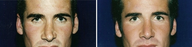 Non-surgical Rhinoplasty, Before and After