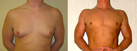 Male Breast Reduction