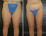 Thigh Lift