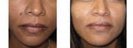 Mole Removal photos