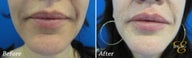 Juvederm