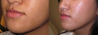 Mole removal using plastic surgery techniques
