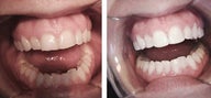 Dental Bridge and Bonding Procedure