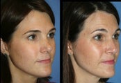 Revision Rhinoplasty