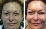 64 yo African American TCA peel and Sculptra
