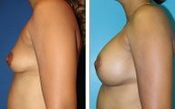 Breast Lift- Mastopexy