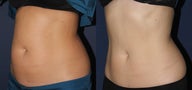 Before and After CoolSculpting
