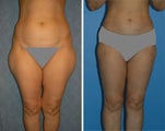 Liposuction