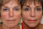 Non-Surgical Facial Rejuvenation with Silikon-1000