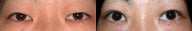 Asian Eyelid Surgery