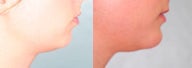 Chin Augmentation