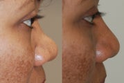 Non-Surgical Rhinoplasty with Silikon-1000