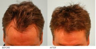 Hair Transplant