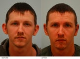 Otoplasty