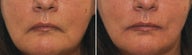 Lower Face Filler
