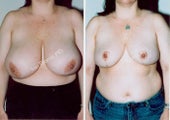 Breast Reduction