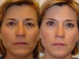 Botox/Fillers