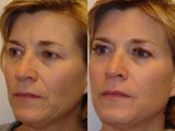 Botox/Fillers