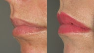 Lip Augmentation