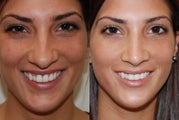Rhinoplasty Surgery