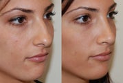 Rhinoplasty Surgery