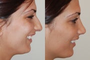 Rhinoplasty Surgery