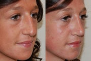Rhinoplasty Surgery