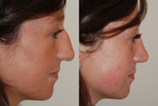 Rhinoplasty Surgery