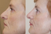 Non-Surgical Rhinoplasty with Silikon-1000