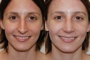 Rhinoplasty Surgery. 1 month post-op.