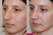 Rhinoplasty Surgery. 1 month post-op.