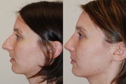Rhinoplasty Surgery. 1 month post-op.
