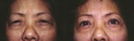Asian upper blepharoplasty