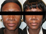 African American Rhinoplasty