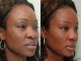 African American Rhinoplasty