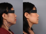 Smartlipo of the neck with Radiesse in the Mid-face