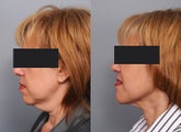 Smartlipo Neck Lift