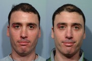 Revision rhinoplasty