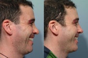Revision rhinoplasty