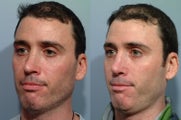 Revision rhinoplasty