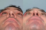 Revision rhinoplasty