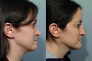 Revision rhinoplasty