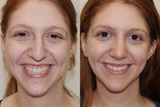 Rhinoplasty Surgery. 5 weeks post-op