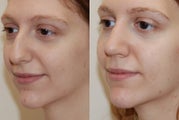 Rhinoplasty Surgery. 5 weeks post-op.