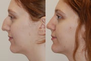 Rhinoplasty (Nose Job) Surgery. 5 weeks post-op.