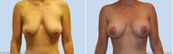Breast Lift